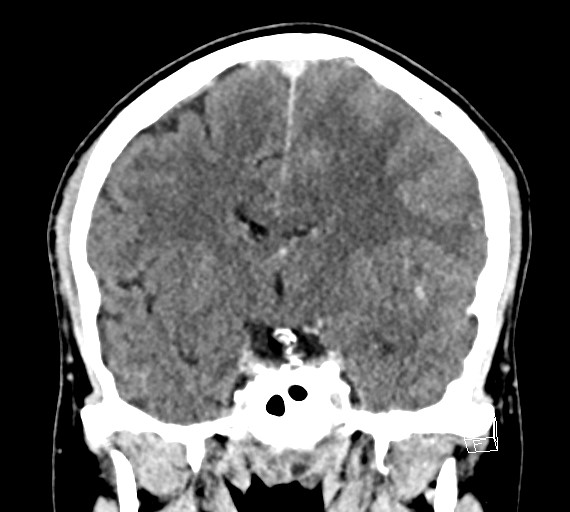 Cerebral metastases - testicular choriocarcinoma (Radiopaedia 84486-99855 D 30).jpg