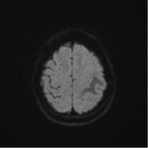 Cerebral metastasis (Radiopaedia 46744-51248 Axial DWI 51).png