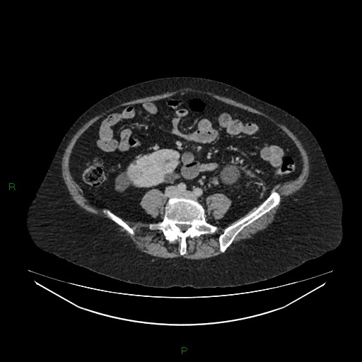 Cerebral metastasis from renal cell carcinoma (Radiopaedia 82306-96378 A 115).jpg