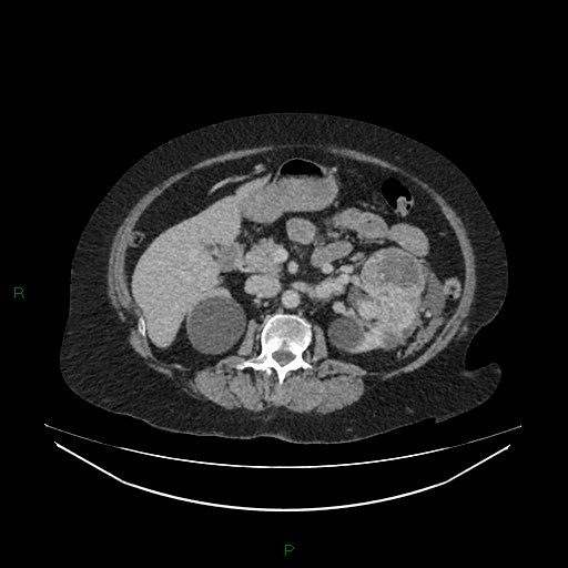 File:Cerebral metastasis from renal cell carcinoma (Radiopaedia 82306-96378 A 69).jpg