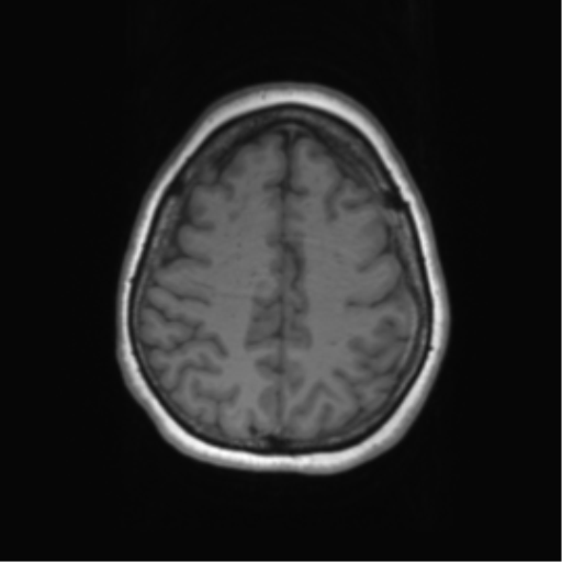 Cerebral metastasis mimicking glioblastoma (Radiopaedia 69155-78937 Axial T1 52).png