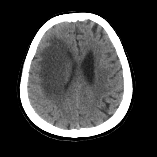 Cerebral metastasis to basal ganglia (Radiopaedia 81568-95412 Axial non-contrast 43).png