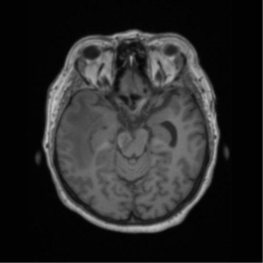 Cerebral metastasis to basal ganglia (Radiopaedia 81568-95413 Axial T1 26).png