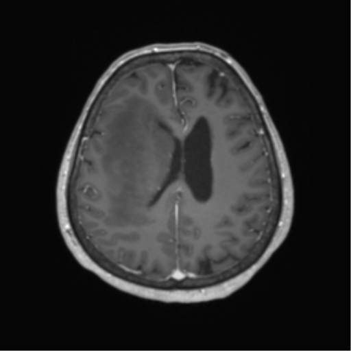 Cerebral metastasis to basal ganglia (Radiopaedia 81568-95413 Axial T1 C+ 50).png