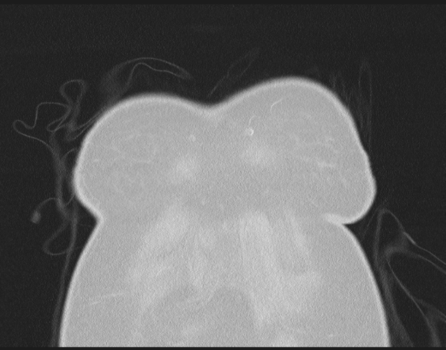 File:Cerebral metastasis to basal ganglia (Radiopaedia 81568-95414 Coronal lung window 9).png