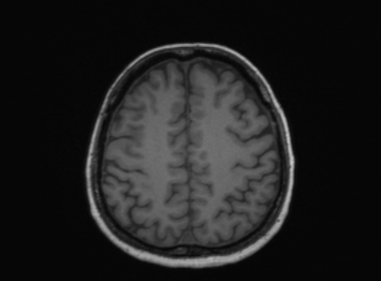 Cerebral ring enhancing lesions - cerebral metastases (Radiopaedia 44922-48817 Axial T1 163).jpg