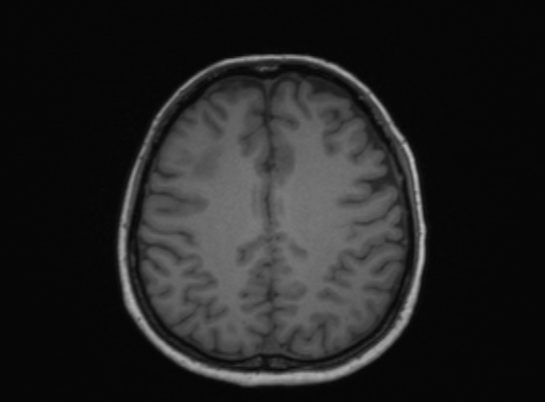 Cerebral ring enhancing lesions - cerebral metastases (Radiopaedia 44922-48817 Axial T1 178).jpg