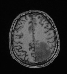 Cerebral toxoplasmosis (Radiopaedia 43956-47461 Axial T1 57).jpg