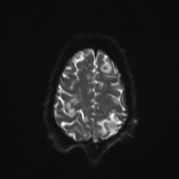 Cerebral toxoplasmosis (Radiopaedia 53993-60132 Axial DWI 23).jpg