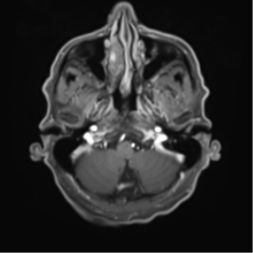 Cerebral toxoplasmosis (Radiopaedia 54575-60804 Axial T1 C+ 11).png