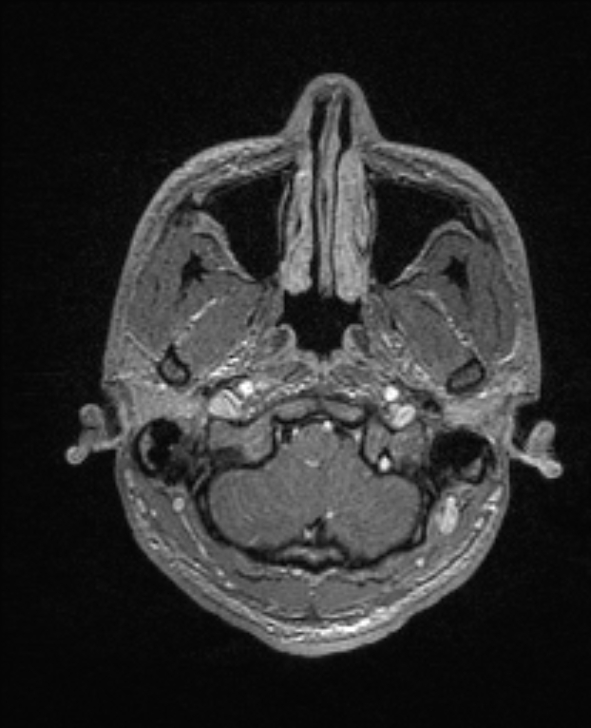 Cerebral toxoplasmosis (Radiopaedia 85779-101597 Axial T1 C+ 21).jpg