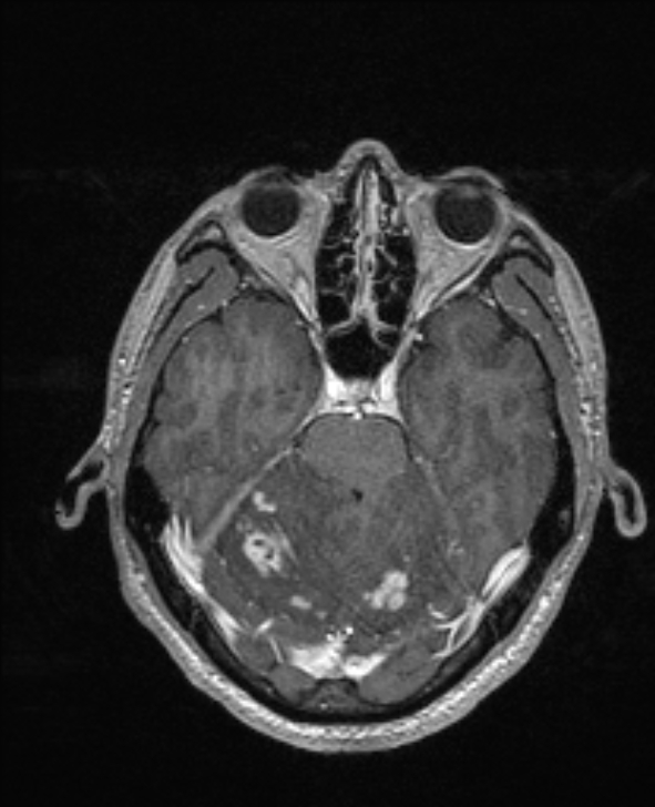 Cerebral toxoplasmosis (Radiopaedia 85779-101597 Axial T1 C+ 53).jpg