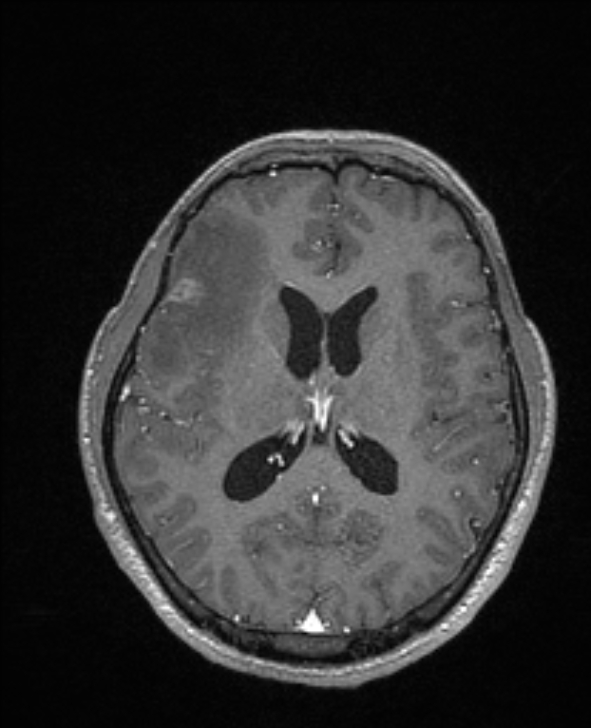Cerebral toxoplasmosis (Radiopaedia 85779-101597 Axial T1 C+ 94).jpg
