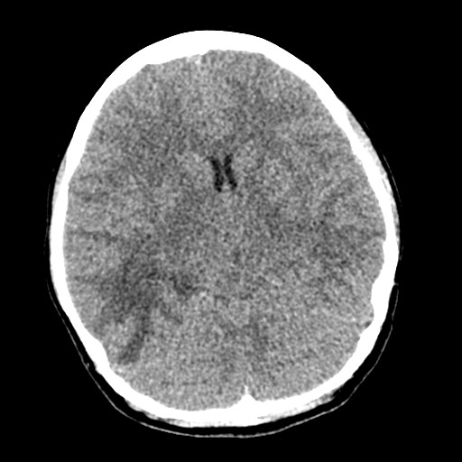 Cerebral tuberculosis with dural sinus invasion (Radiopaedia 60353-68018 Axial non-contrast 25).jpg