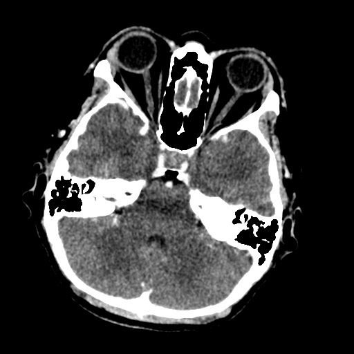 Cerebral tuberculosis with dural sinus invasion (Radiopaedia 60353-68019 Axial C+ delayed 16).jpg
