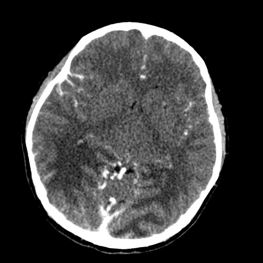 Cerebral tuberculosis with dural sinus invasion (Radiopaedia 60353-68019 Axial C+ delayed 29).jpg