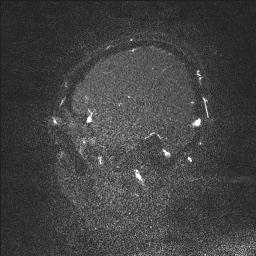 Cerebral tuberculosis with dural sinus invasion (Radiopaedia 60353-68090 Sagittal MRV 17).jpg