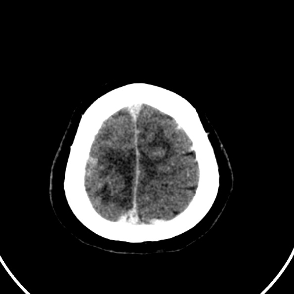 Cerebral venous hemorrhagic infarct from venous sinus thrombosis (Radiopaedia 55433-61883 Axial C+ delayed 21).jpg