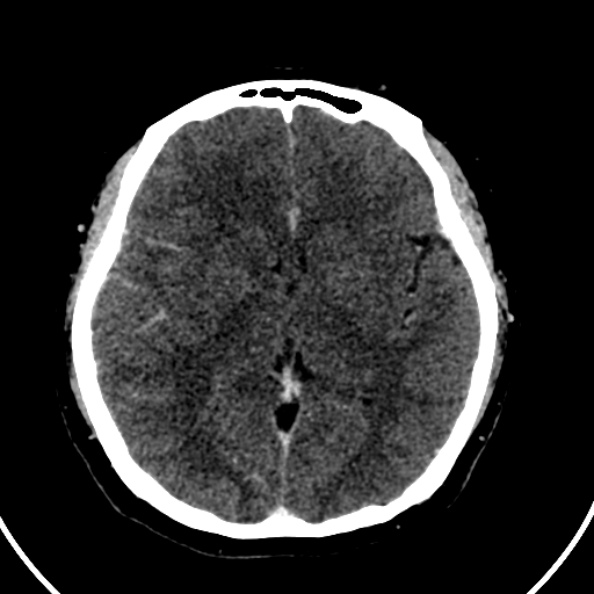 File:Cerebral venous hemorrhagic infarct from venous sinus thrombosis (Radiopaedia 55433-61883 Axial C+ delayed 76).jpg