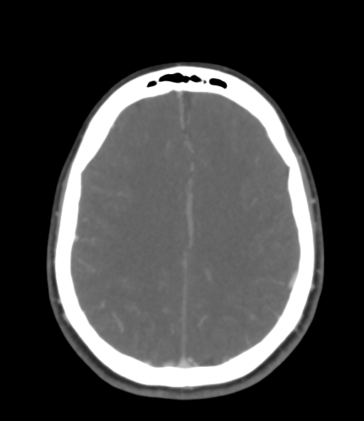 File:Cerebral venous hemorrhagic infarction (Radiopaedia 38461-40550 Axial MIP VENOGRAM 36).png