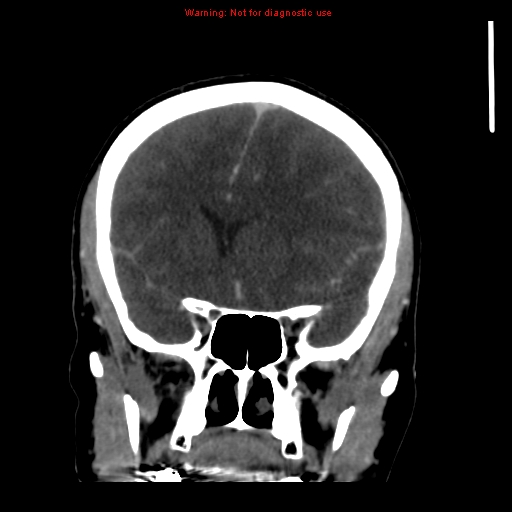 Cerebral venous infarction (Radiopaedia 12404-20735 B 28).jpg