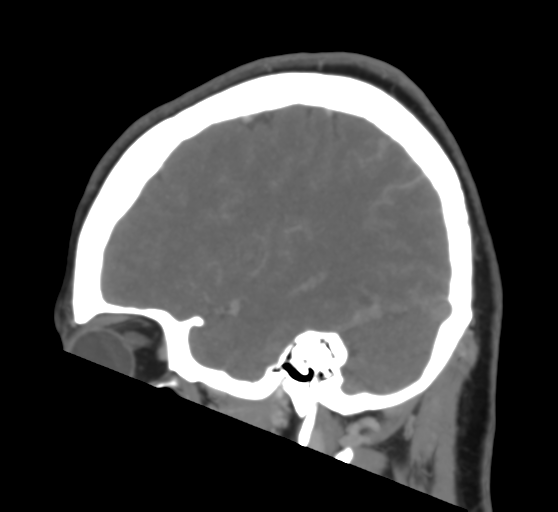 Cerebral venous infarction due to transverse sinus thrombosis (Radiopaedia 34688-36120 Sagittal CT venogram 17).png