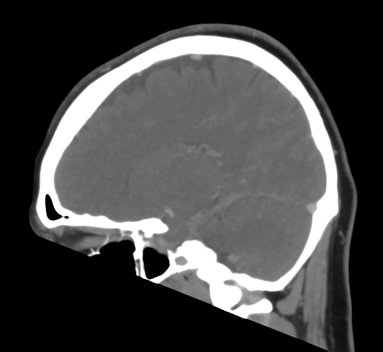Cerebral venous infarction due to transverse sinus thrombosis (Radiopaedia 34688-36120 Sagittal CT venogram 33).png