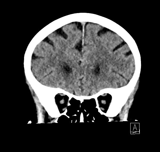 File:Cerebral venous infarction with hemorrhage (Radiopaedia 65343-74381 Coronal non-contrast 13).jpg