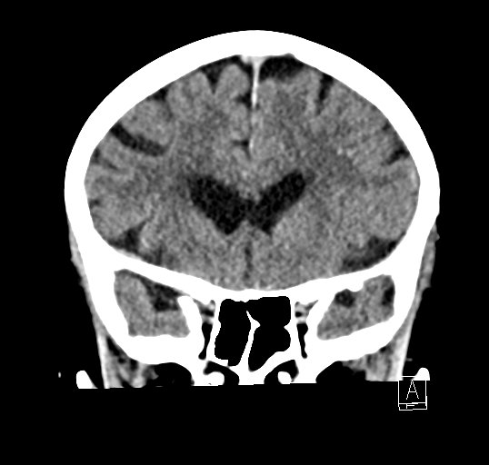 Cerebral venous infarction with hemorrhage (Radiopaedia 65343-74381 Coronal non-contrast 16).jpg