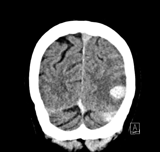 Cerebral venous infarction with hemorrhage (Radiopaedia 65343-74381 Coronal non-contrast 49).jpg