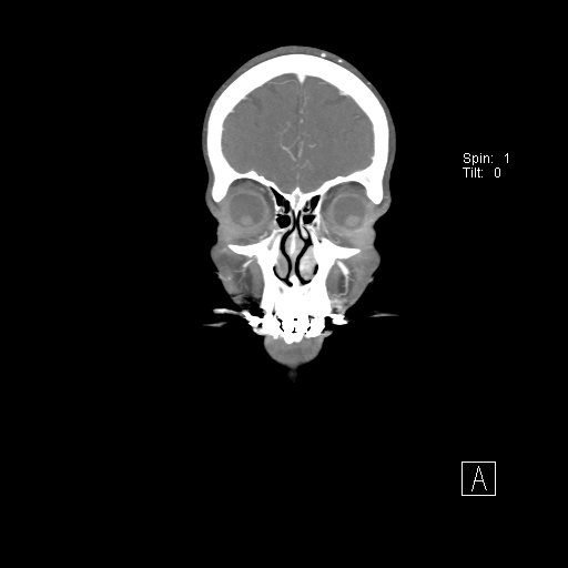 Cerebral venous infarction with hemorrhage (Radiopaedia 65343-74396 B 35).jpg