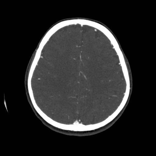 Cerebral venous sinus thrombosis (Radiopaedia 40619-43227 A 163).jpg