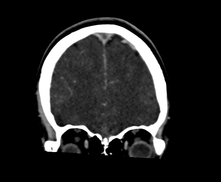 Cerebral venous sinus thrombosis (Radiopaedia 59224-66646 Coronal C+ delayed 14).jpg