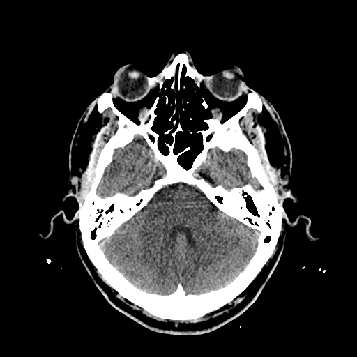 File:Cerebral venous thrombosis (CVT) (Radiopaedia 77524-89685 Axial non-contrast 12).jpg