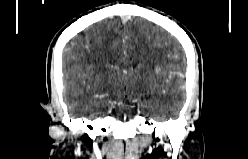 Cerebral venous thrombosis (CVT) (Radiopaedia 77524-89685 C 33).jpg