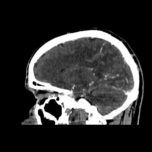 File:Cerebral venous thrombosis (CVT) (Radiopaedia 77524-89685 Sagittal CTV 28).jpg