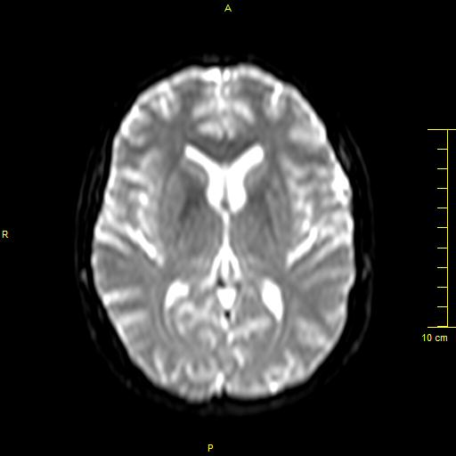 File:Cerebral venous thrombosis (Radiopaedia 23288-23351 Axial DWI 20).JPG