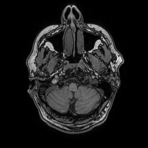 File:Cerebral venous thrombosis with secondary intracranial hypertension (Radiopaedia 89842-106957 Axial T1 40).jpg