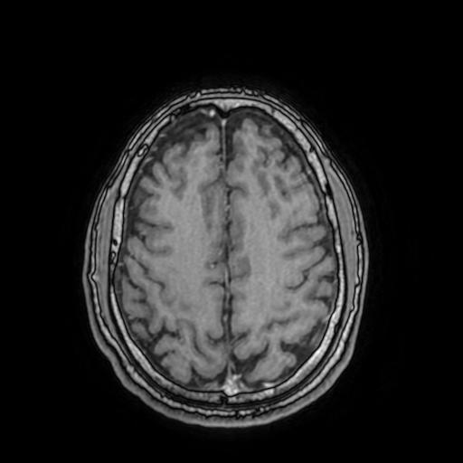 File:Cerebral venous thrombosis with secondary intracranial hypertension (Radiopaedia 89842-106957 Axial T1 C+ 129).jpg