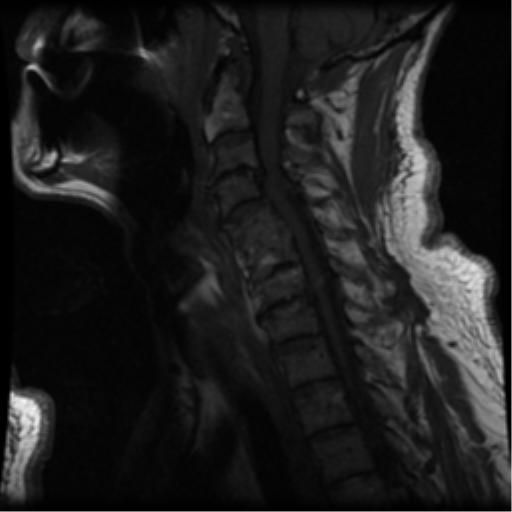 File:Cervical canal stenosis with cord compression (Radiopaedia 34114-35374 Sagittal T1 8).png