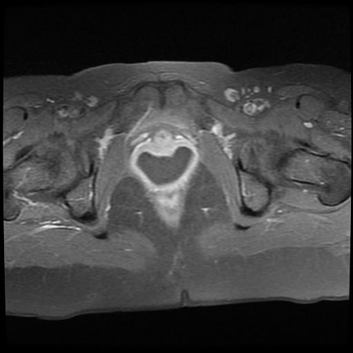 File:Cervical cancer (Radiopaedia 62991-71413 Axial T1 C+ fat sat 16).jpg