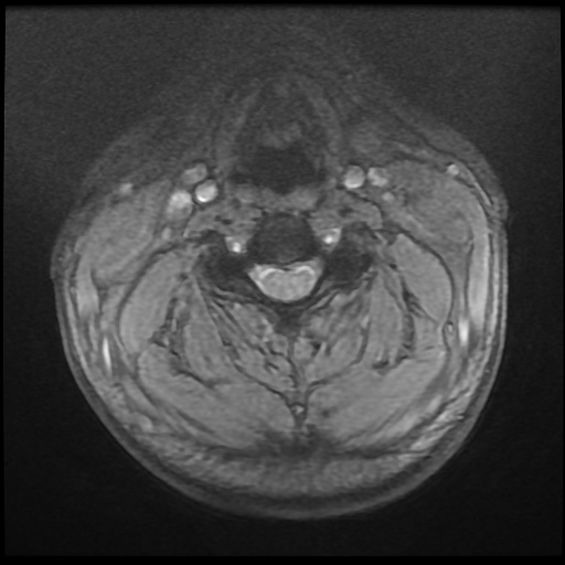 Cervical disc extrusion (Radiopaedia 59074-66364 F 15).jpg