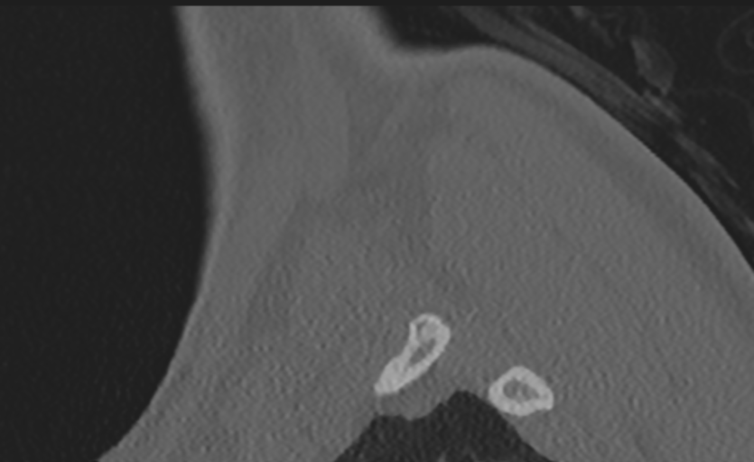 Cervical disc replacement (Radiopaedia 37383-39205 Sagittal bone window 4).png