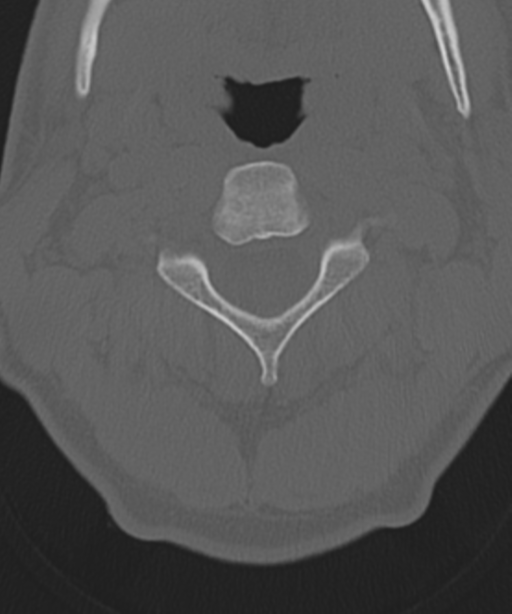 Cervical intercalary bone (Radiopaedia 35211-36748 Axial bone window 21).png