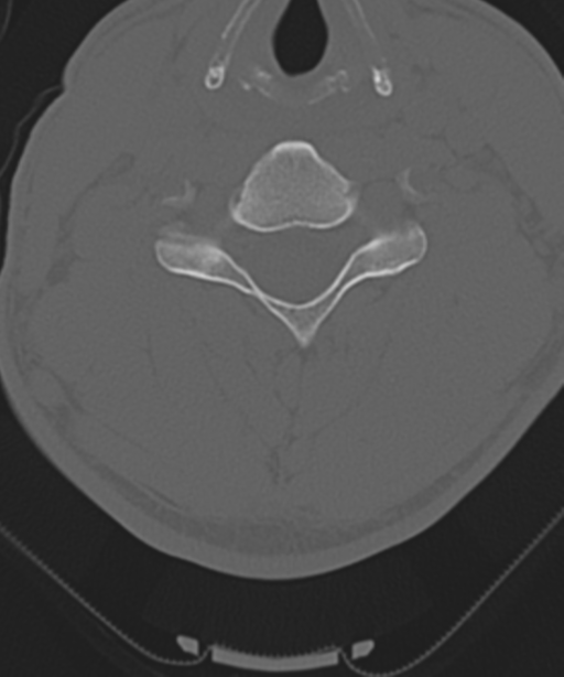 Cervical intercalary bone (Radiopaedia 35211-36748 Axial bone window 39).png