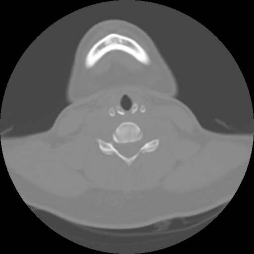 Cervical rib (Radiopaedia 71110-81363 Axial non-contrast 37).jpg