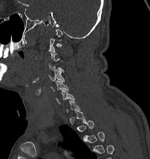 Cervical spine trauma with tear drop fracture and perched facet joint (Radiopaedia 53989-60127 Sagittal bone window 27).jpg