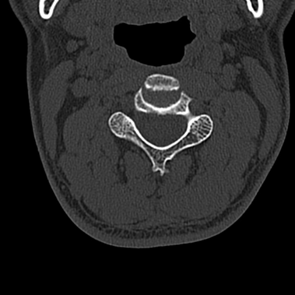Cervical spondylodiscitis (Radiopaedia 28057-29489 Axial bone window 31).jpg