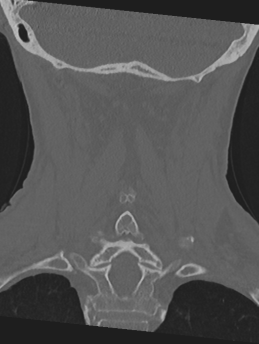 Cervical spondylolysis (Radiopaedia 49616-54811 Coronal bone window 41).png
