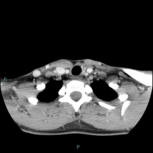 Cervical thymic cyst (Radiopaedia 88632-105335 C 33).jpg